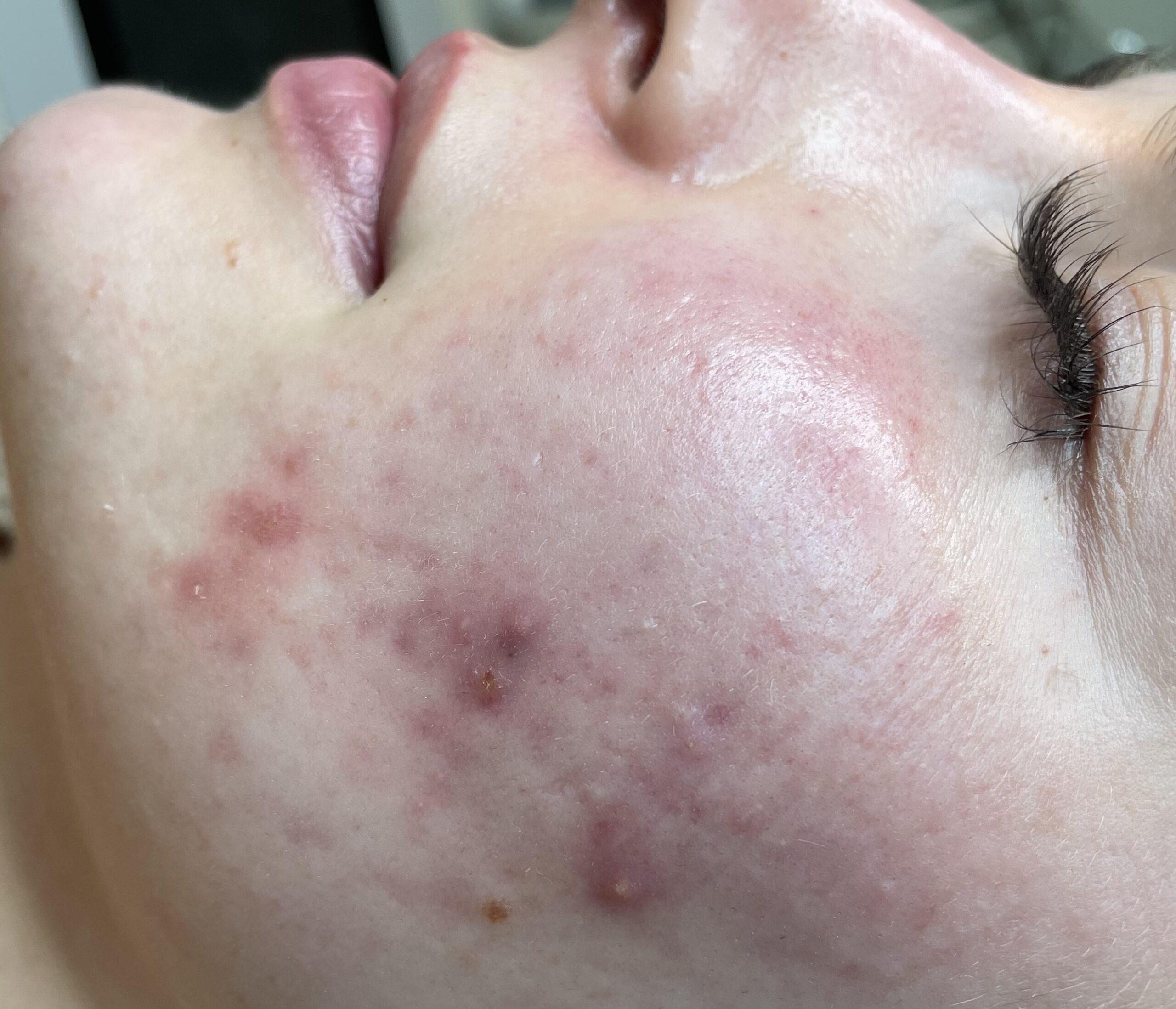 PRODERM TDA 护理前