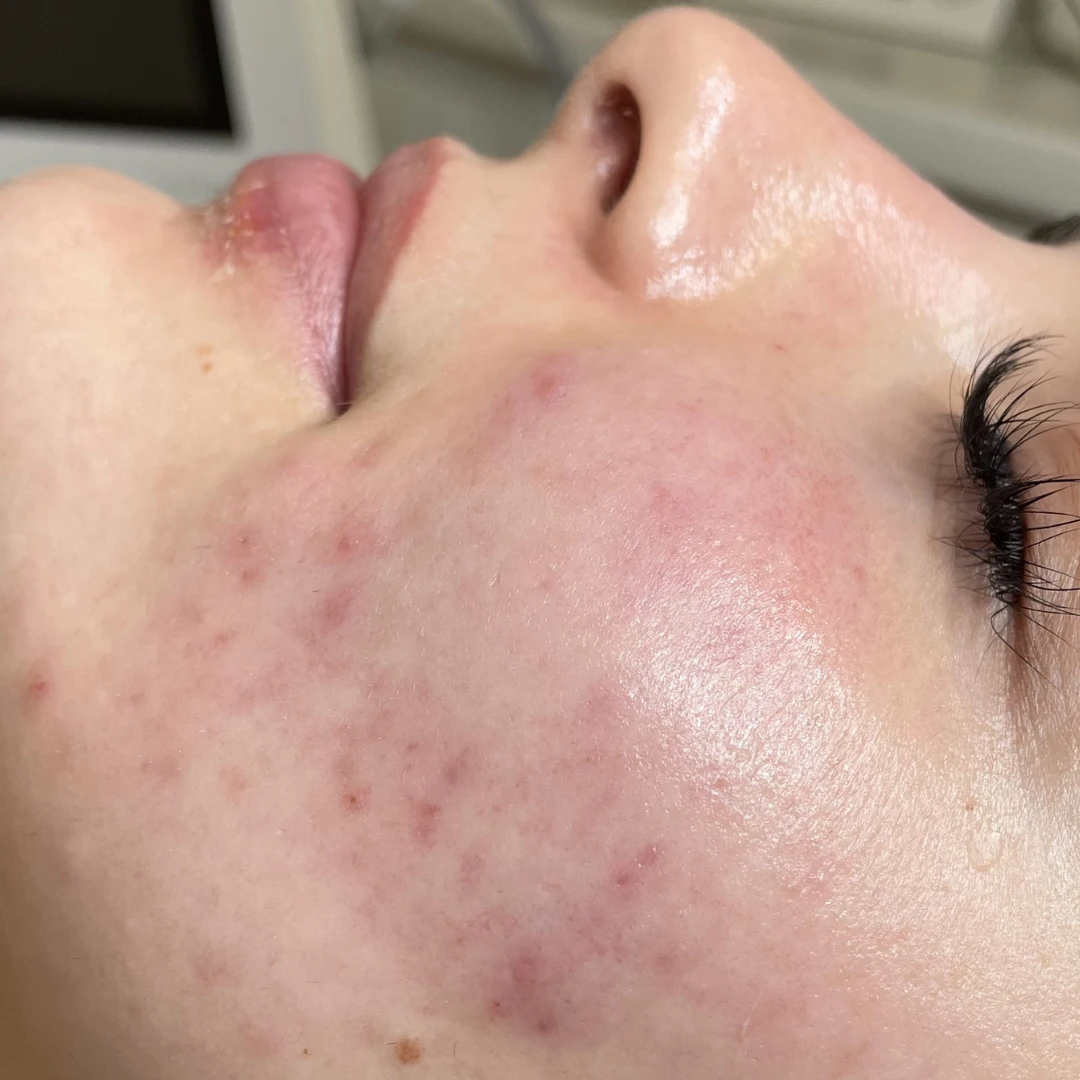 PRODERM TDA 护理后