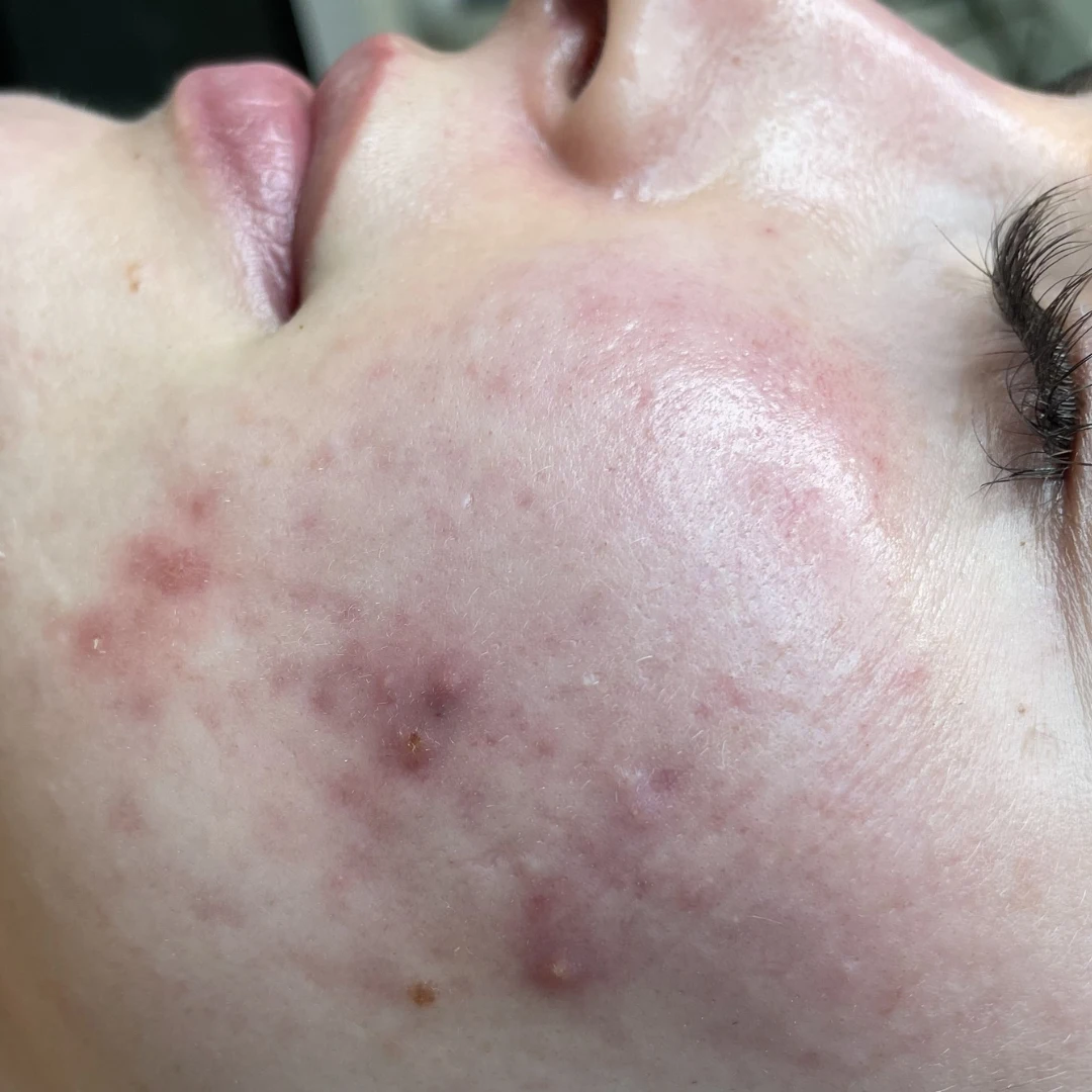PRODERM TDA 护理前